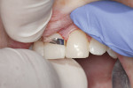 Figure  17  Use of both wide and narrow superfine diamond finishing strips (Cosmedent’s FlexiDiamond Strips). Running these strips once or twice through the contact will smooth the contact area.