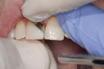Figure  18  Use of both wide and narrow superfine diamond finishing strips (Cosmedent’s FlexiDiamond Strips). Running these strips once or twice through the contact will smooth the contact area.