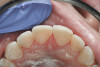 Figure 8  Osseous crown lengthening was performed using the incisal edge position of the temporary to determine bone and gingival levels.