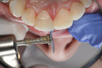 Figure  20  Further refinement of the mesial–labial line angle to further refine embrasure space and create symmetry of both centrals. Here, the use of the medium-grit (FlexiDisc) is preferred.