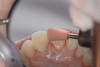 Figure 13  Brackets on the lower incisors are removed so they can be direct-bonded.