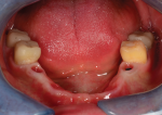 Fig 1. The patient's initial oral situation following integration of four implants.