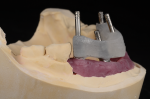 Fig 7. The verification jig shows a situation with limited space at tooth No. 30.