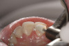 Figure 16  View of the teeth following trimming and shaping, ready to be re-bracketed for the completion of orthodontics.