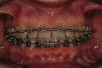 Figure 2c  Initial orthodontics to create space for intermediate restorations. Note the exaggerated spacing of the anterior upper teeth. Alignment of the gingiva and initial leveling.