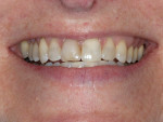 Figure  2   The full smile displayed a short thin upper lip and a reverse smile line. There was a gummy display on the upper left of the smile.