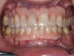 Figure  3  The old anterior composites were leaking but had no decay. There was a 25-year-old crown in tooth No. 8 causing the tooth and its root to be dark. The 7-year-old crowns on the upper left had been done prior to bleaching and were slightly d