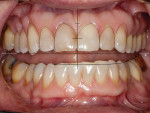 Figure  4  The lower incisal edges were uneven with an incisal cant. The plan was to lengthen teeth Nos. 7 through 10 and shorten and align the lower incisal edges by enameloplasty. There was gingival clefting above teeth Nos. 4 through 6.