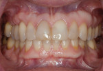 Figure  5  A large subepithelial connective tissue graft was placed above teeth Nos. 4 through 6 by the periodontist (Dave McClenahan, Lake Forest, Illinois) using the palate as the harvest site. Healing time was 4 months.