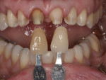 Figure  6  Tooth preparation was extensive due to the uneven value and chromatic nature of the tooth stumps.