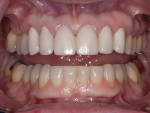 Figure  9  Because of the bruxism habit, care was taken to not steepen the anterior guidance. Though the upper teeth were lengthened, the lower edges were plastied to maintain the steepness of guidance.
