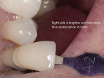 Figure  10  The right cuspid needed to match A-2 and had more incisal blue opalescence.