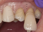 Figure  11  The left cuspid needed to match the A-3 premolar crown.