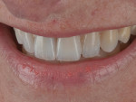 Figure  13  Ideally, gingival to incisal chroma gradients are best created by allowing the natural chroma of the tooth to show through the porcelain rather than with superficial stains.