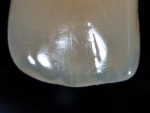 Figure  16  Opalescence causes translucent enamel to reflect blue light back to the observer.