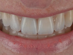 Figure  18  Final close-up achieving the patient-driven agendas of morphological symmetry, chromatic uniformity with brightness and translucency, a natural incisal display with opalescent blue, and an incisal halo.