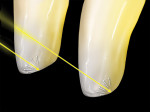Figure  20  A natural halo is caused by the reflection off the internal lingual–incisal surface of enamel or the incisal wear facet. The angle of the wear facet will determine if the halo is present. A 30° or more (from horizontal) incisal wear fa