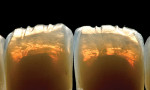 Figure  21  An angled surface has been created on the pressed copings with a high enough angle to scatter the red–yellow wavelengths. This will create a natural-looking incisal halo.