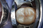 Class I dental caries lesion in mandibular second molar.