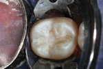 RMGI-type material injected, light hardened, and trimmed to form a dentin replacement base.