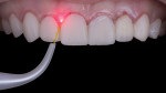 Trial smile was used as a template for gingivectomy.