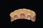 Figure  4  CASE PRESENTATION The provisional resin-based FPD was relieved on the lingual to accommodate implant components.