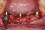 Figure  5  CASE PRESENTATION  Multi-unit abutments were placed on the implantsand torqued to 30 Ncm.