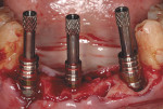 Figure  6  CASE PRESENTATION Gold cylinders were secured to the multi-unit abutments using waxing pins.