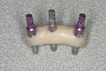 Figure  8  CASE PRESENTATION The tissue-side of the provisional FPD before polishing. Implant analogs were connected to the gold cylinders to protect their surface during finishing procedures.