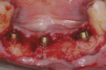 Figure  9  CASE PRESENTATION Demineralized bone putty was placed around the implants.