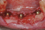 Figure  10  CASE PRESENTATION A regenerative membrane was placed over the facial defect on site No. 27.