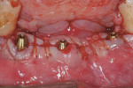 Figure  11  CASE PRESENTATION Flaps were secured using continuous 4.0 chromic gut suture.