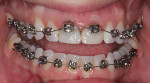 Fig 4. Brackets placed on provisional crowns for extrusion.