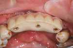 Figure  13  CASE PRESENTATION Occlusal view showing the screw-access holes and retaining screws.
