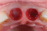 Fig 9. Tissue had migrated under the natural
tooth provisional restorations.
