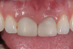 Fig 10. Screw-retained provisional crowns.