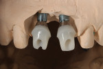 Fig 11. Implants on cast with titanium and lithium-disilicate abutments.
