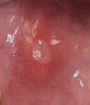 Fig 4. Classic appearance of an aphthous ulcer associated with BD.