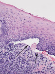 Fig 3. Subepithelial cleft (arrows) resulting in
complete separation of the mucosal epithelium
from the underlying lamina propria within this
region (hematoxylin-eosin 200X).