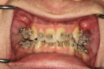 Fig 1. Pre-orthodontic photograph showed patient with class 1 malocclusion with crowding of the mandibular and maxillary dentitions. (Brackets were in place at time of photograph, though pre-orthodontic movement is shown.)