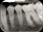 Fig 7. Radiograph made 3 months post-orthodontic movement. Note the complete radiographic fill of the mesial infrabony defect and re-establishment of the lamina dura.