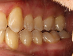 Fig 10. Four-year post-orthodontic follow-up, occlusal view (Fig 9) and left side buccal view (Fig 10), which indicated stable, healthy gingival levels at No. 19 with no obvious signs of inflammation.