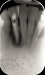 Fig 12. Initial radiographic presentation. Note the large periapical defect that was affecting
the supporting bone of both teeth Nos. 25 and 26.