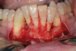 Fig 13. A full-thickness mucoperiosteal flap was elevated on the buccal and lingual aspects of the mandibular anterior teeth. Note the moderate to severe bone loss and thin buccal plate associated with all mandibular incisors.