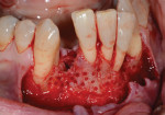 Fig 14. Atraumatic extraction of tooth No. 26 was performed. Round corticotomies were made on the buccal aspect of the mandibular anterior bone.