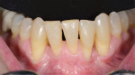 Fig 17. Debonding after 10 months of orthodontic tooth movement. A fixed bar was cemented on the lingual aspects of teeth Nos. 22 through 27 to provide retention.