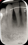 Fig 20. At 2 years post-orthodontic tooth
movement, note the continuing maturation of the grafted extraction site and the development of the lamina dura and PDL space.