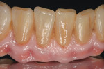 Figure  16 TRY-IN Close up view of the definitive zirconia implant FPD. All the subtleties and nuances of the patient’s natural dentition were reproducedin the prosthesis.