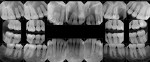 Fig 23. Full-mouth x-ray series. Note the root resorption of all premolars and maxillary incisors.