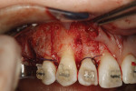 Fig 25. Corticotomies were made on the buccal and lingual aspects of all teeth exposed in the surgical sites.